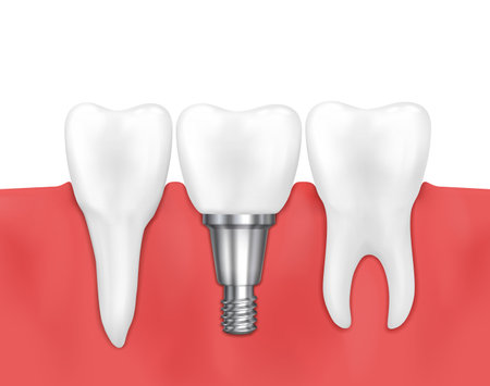 Dental implant and normal tooth vector illustrationのイラスト素材