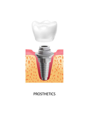 Realistic tooth stages dental implant composition with text and view of prosthetics stage of dental implantation vector illustrationのイラスト素材