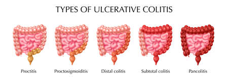 Ulcerative colitis types infographics including proctitis distal colitis pancolitis proctosigmoiditis subtotal colitis realistic vector illustrationのイラスト素材