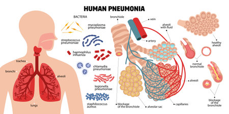 Human pneumonia composition with icons of infectious bacteria human lungs parts and text captions with pointers vector illustrationのイラスト素材