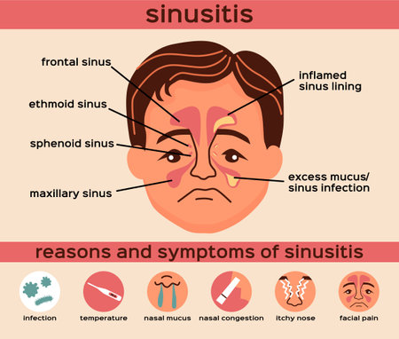 Nasal disease flat infographics layout with reasons and symptoms of sinusitis vector illustrationのイラスト素材