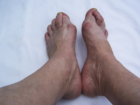 Bare foots which have Hallux Valgus (bunion) problem.