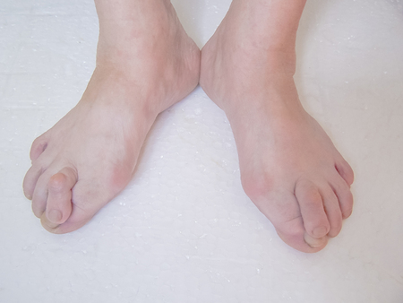 Bare foots which have Hallux Valgus problem.の写真素材
