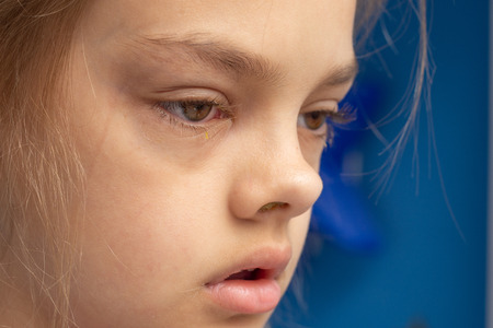 Ill child, conjunctivitis on the eyesの写真素材