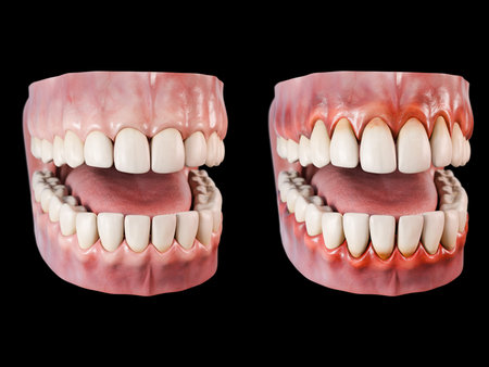This 3d illustration shows the periodontitis diseaseの写真素材