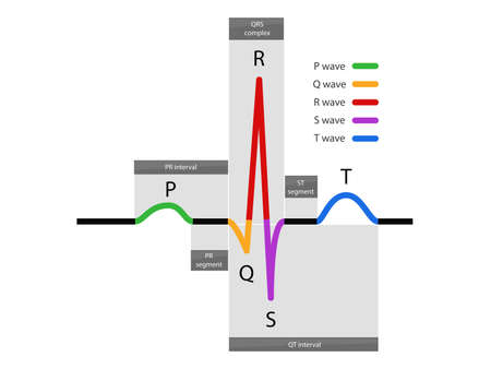 ecg waveform, Normal Atrial And Ventricular Depolarization With