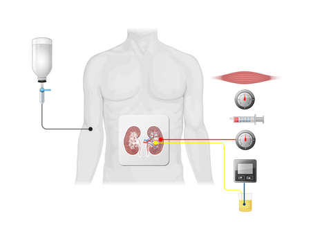 Urine glucometer test normal and abnormal results in patient urine sample. 3d 2d graphic...