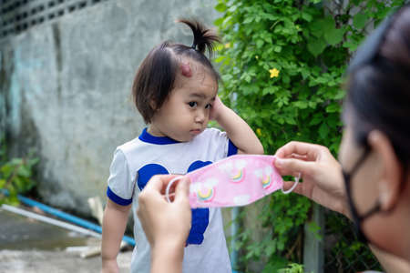 Adorable little child girl with big capillary strawberry hemangiomas red birthmark on head refuses to wear medical face mask that the mother or guardian are trying to put on face. Health care conceptの写真素材