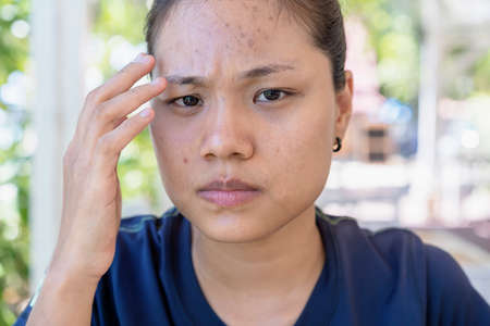 Young Asian woman worry about her face when she has problems with skin on her face in a natural background. Problems with acne and scar on the female skin. Problem skincare and health concept.の写真素材