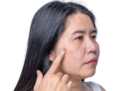 Close up of Asian adult woman face has freckles, large pores, blackhead pimple and scars problem from not take care for a long time. Soft focus of skin problem face. Treatment and Skincare conceptの写真素材