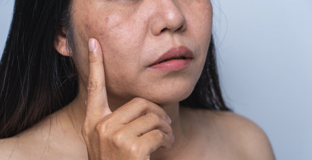 Woman with facial skin problems of freckles, dark spots, and wrinkles on the face Enlarged pores on combination skin Expressing a tense, thoughtful expression Dull and rough skin  Healthy concept.の写真素材