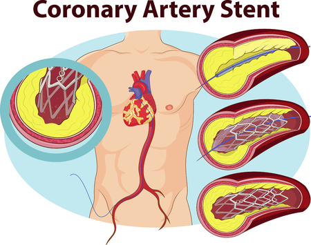 Vector illustration of Coronary artery stentのイラスト素材