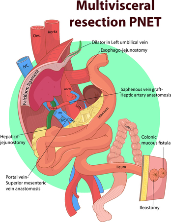 Vector illustration of Intestinal and Multivisceral  anatomyのイラスト素材