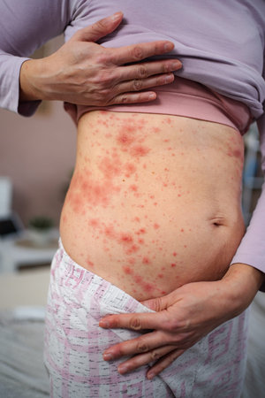 Woman showing red rash on stomach skinの写真素材