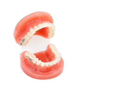 Orthodontic model and dentist tool - demonstration teeth model with ceramic braces on teeth on an...