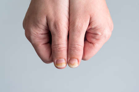 Onychomycosis or fungal nail infection on damaged nails after gel polish, onychosis. Longitudinal ridging nails with psoriasis. Nail diseases, health and beauty problemの写真素材