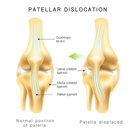 Normal position of kneecap and patella displaced. Illustration isolated on white background. Graphic concept for your designのイラスト素材