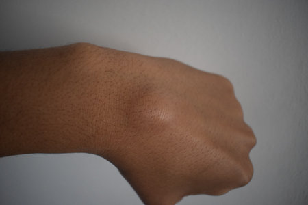 non edited photo of A close-up image of a human hand featuring a prominent, smooth, round lump on...