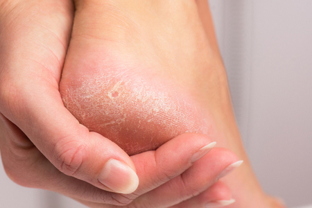 Female heel with hardened skin.