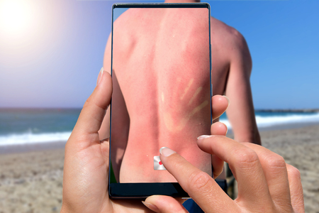 Woman photographing on cell phone sunburned back man by the sea.
