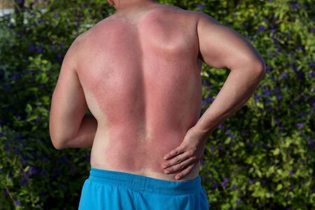Sunburned painful back man from the sun. Painful sunburn red skin on holiday.の写真素材