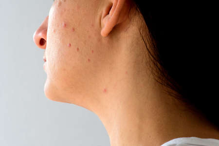 Woman with problematic skin and acne, closeupの写真素材