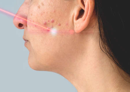 Woman with acne repair damaged skin with laser. Skin care concept.の写真素材