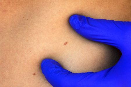 close up, dermatologigist doctor examines preventive screening for skin cancer.の写真素材