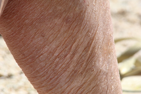 human aging, sagging and aged skin of the human body