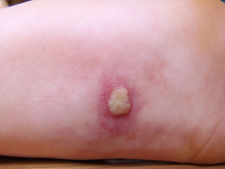 Herpis on the baby's leg is a disease with a characteristic close-up photo rash