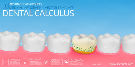 Dental calculus horisontal medical banner template. Vector illustration.のイラスト素材