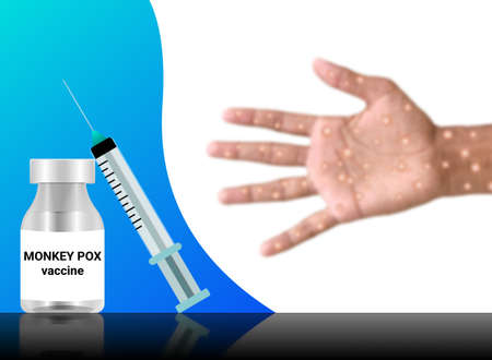 monkey pox virus vaccine and injection on blur infected hand. new pendamic spreading in World...