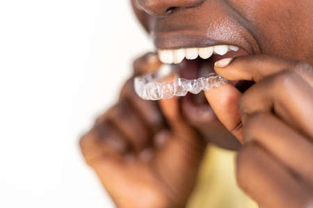 Young woman putting on an invisible dental aligner