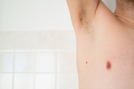 skin wart
