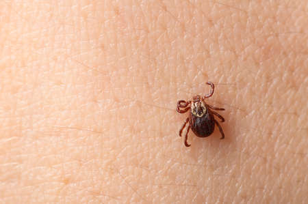 Tick on the skin of a person close-up. Concept of the season for the spread of ticks and diseases transmitted through insect bites.の写真素材
