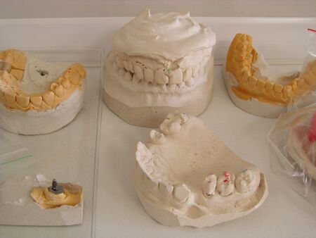 The layout of the jaw of a person with dental implants. Manufacturing and prosthetics of teeth. Dental laboratory.の写真素材