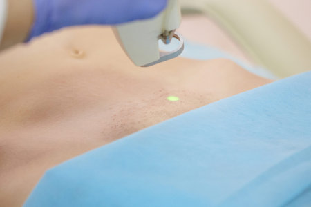 Hair removal cosmetology procedure from a therapist at cosmetic beauty spa clinic. Laser epilation...