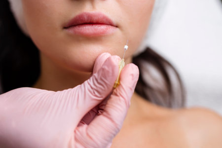 Face lifting PDO Suture operation. innovative technique of New thread lift, cosmetologist preparing...