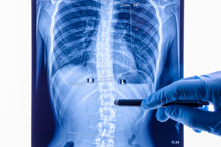 Doctor analyzing X ray of the spine showing scoliosis in the lumbar area. Scoliosis is an abnormal lateral curvature of the spine.の写真素材