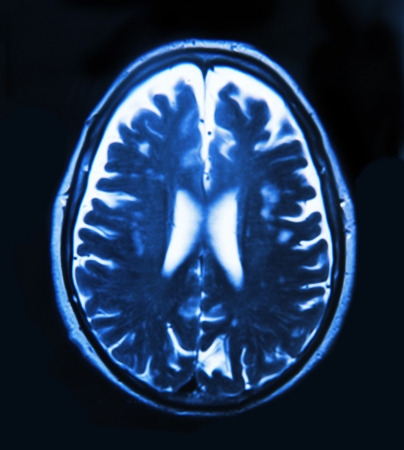 Imaging of the brain on x-rayの写真素材