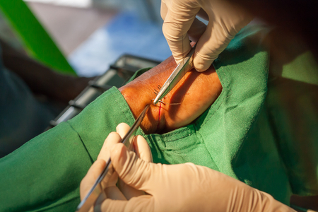 Method bind thread while suturing woundの写真素材