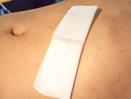 surgical stapler abdominal cavityの写真素材