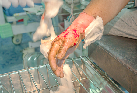 Dressing burned wound hand with gauze padの写真素材