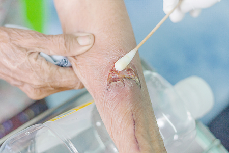 man arm wound dressing setの写真素材