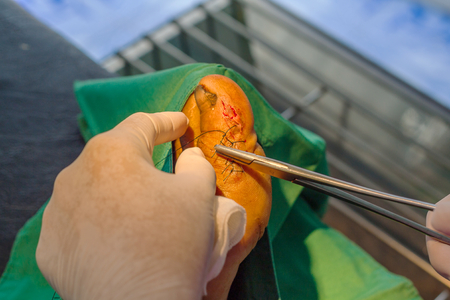 surgical wound foot of manの写真素材