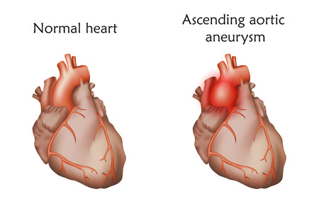 Ascending aortic aneurysm iconのイラスト素材