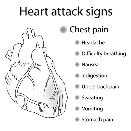 Heart attack signs, symptoms. Myocardial infarction. Damaged heart muscle. Medical, anatomical flat outline illustration.のイラスト素材
