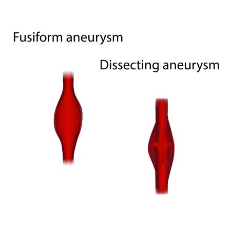 Fusiform and dissecting aneurysm. Medical anatomy illustration.の写真素材
