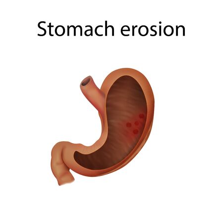 Stomach erosion. Abdominal inflammation. Medical anatomy illustration.の写真素材