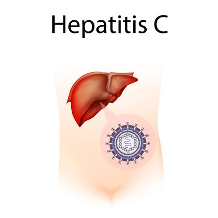 Hepatitis C. Liver inflammation. Medical anatomy illustration.の写真素材